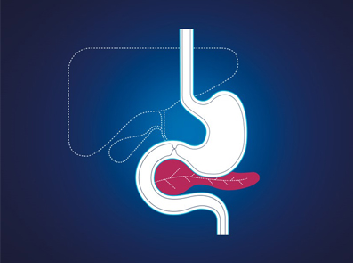 Orsaker till exokrin pankreasinsufficiens