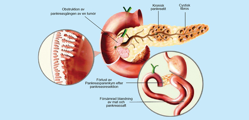 Patologin bakom exokrin pankreasinsufficiens på grund av olika orsaker